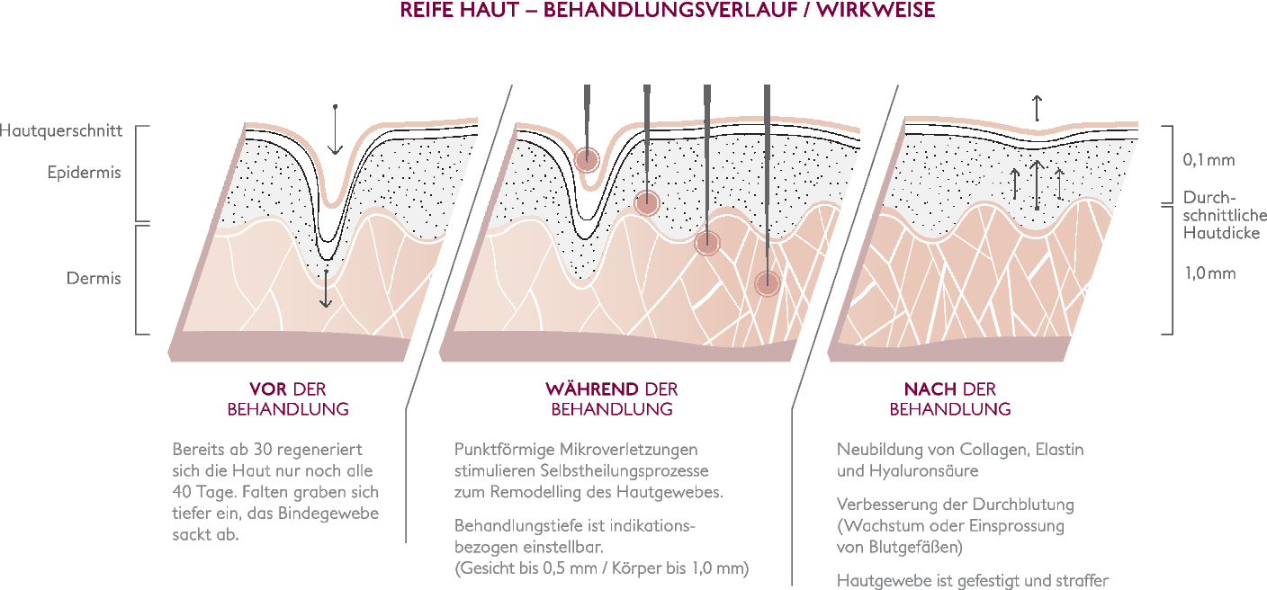 CareforYou Dermaroller – 540 Titan-Mikronadeln, 2,5 Mm, Für Hautverjüngung, Narben & Haarwachstum